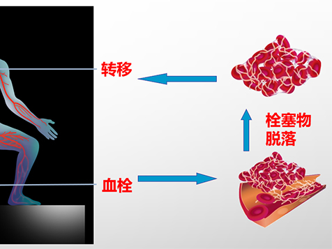 优势学科|锦州市中心医院心血管内三科成功救治一名高危肺动脉栓塞患者