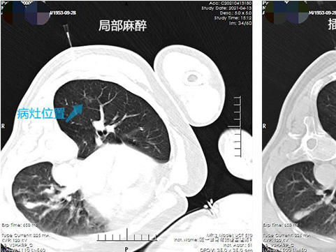 肺结节治疗不开胸 射频消融术治疗效果好