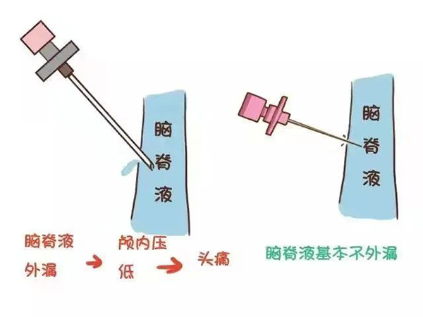 麻醉手术后不需要去枕平卧了 你知道吗？