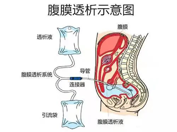 坚持高质量发展 创辽西腹膜透析旗舰品牌