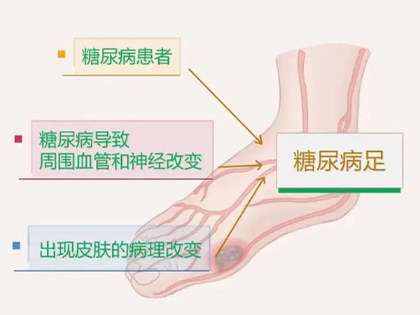 优势学科｜糖尿病足 预防大于治疗 随访同样重要