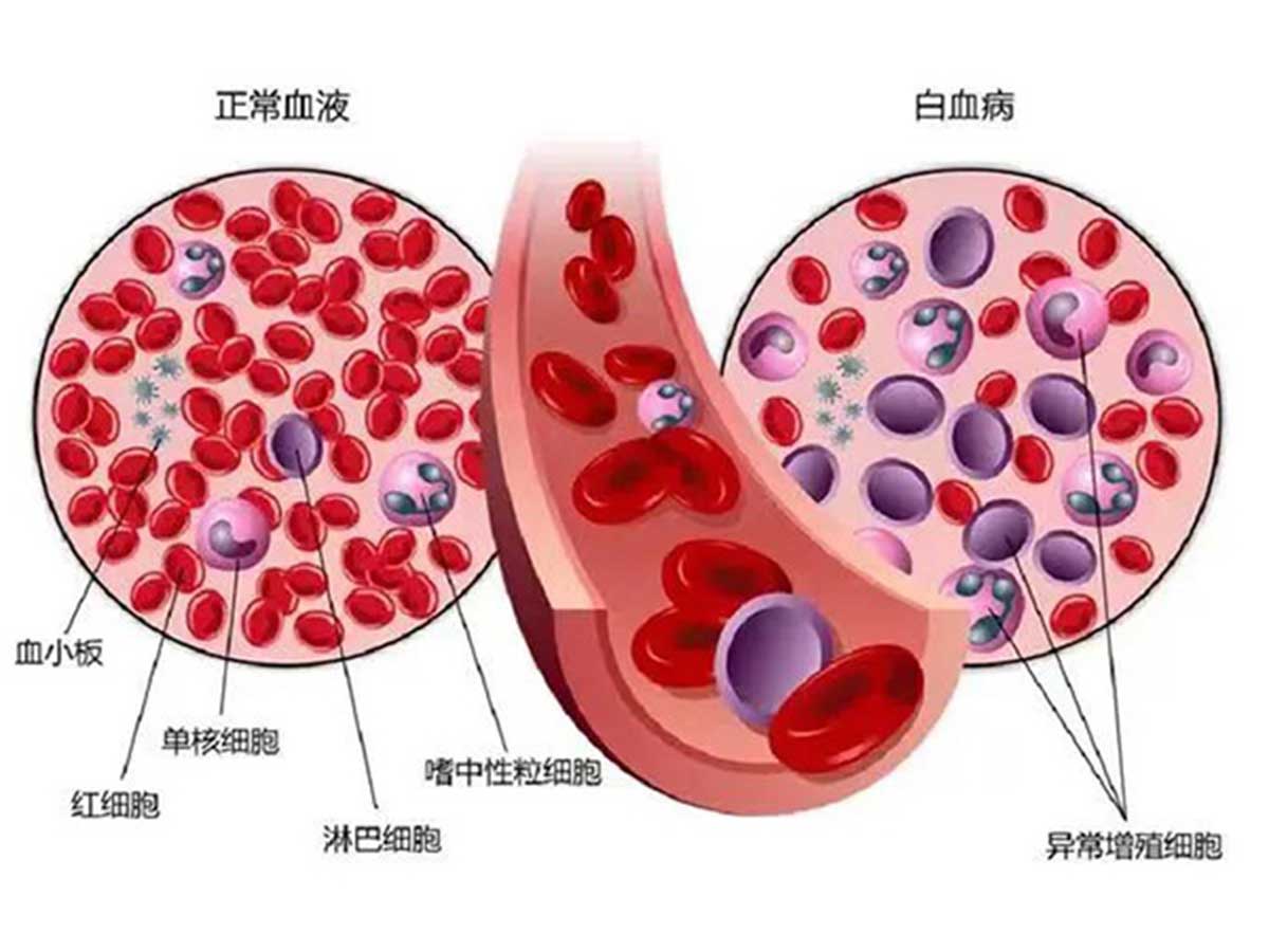 优势学科｜多学科合作 个体化治疗 为老年高危急性髓系白血病合并坏疽性脓皮病患者带来希望