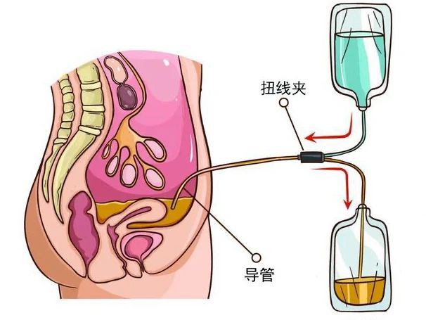 优势学科｜肾脏替代治疗——医 护 患一体化腹膜透析管理模式