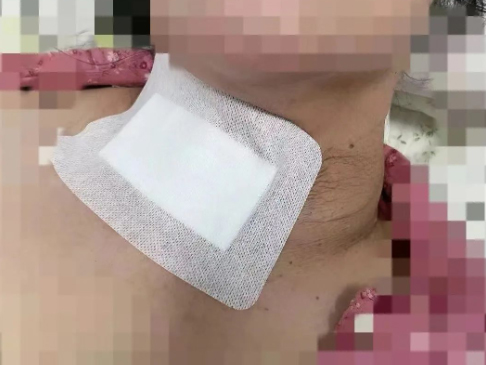 品牌科室｜小切口摘除巨大颈部肿物 中心医院普外一科团队精准外科理念助患者颈部完美如初