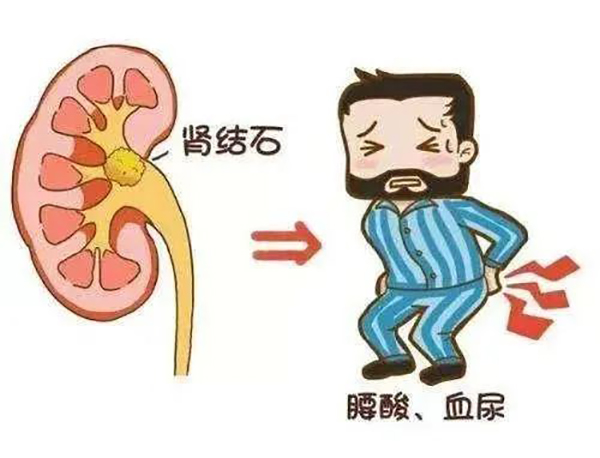 优势技术｜泌尿外科经皮肾镜碎石取石术治疗肾结石 微创技术为患者解除痛苦