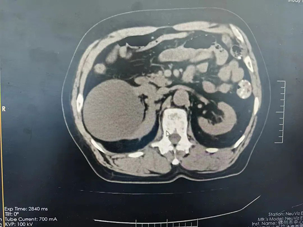 优势技术 | 腹腔镜肾囊肿去顶减压 20分钟解决“大囊肿”