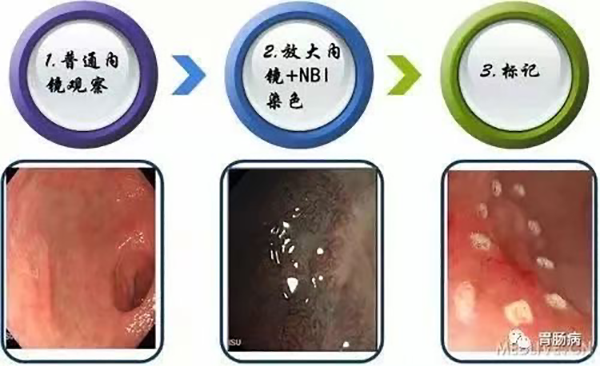 优势技术 | 内镜粘膜下剥离术（ESD）消化道病变的超级微创手术
