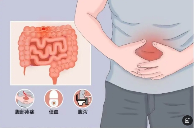 优势技术|消化一科运用生物制剂治疗炎症性肠病