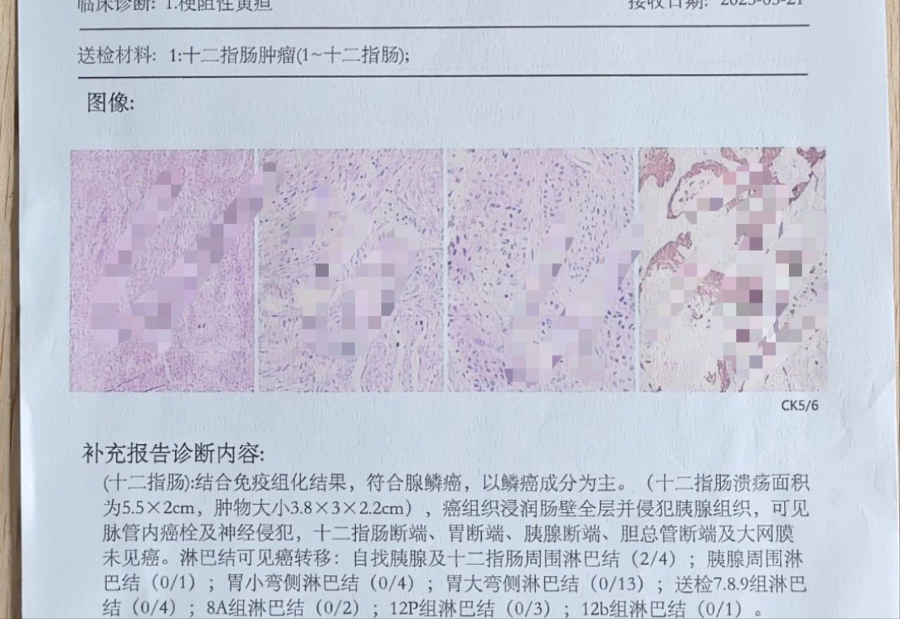 优势技术|普外二科：勇闯胰十二指肠手术禁区 攻克高难度十二指肠占位病变