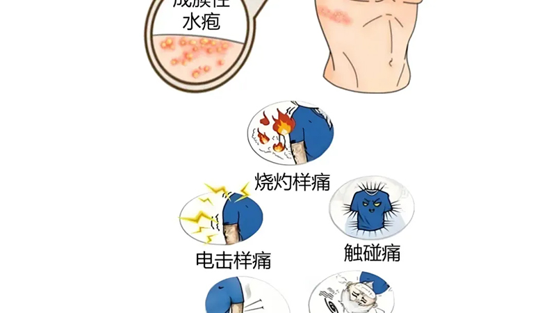 药学科普|带状疱疹如何正确用药？这几点一定要知道！
