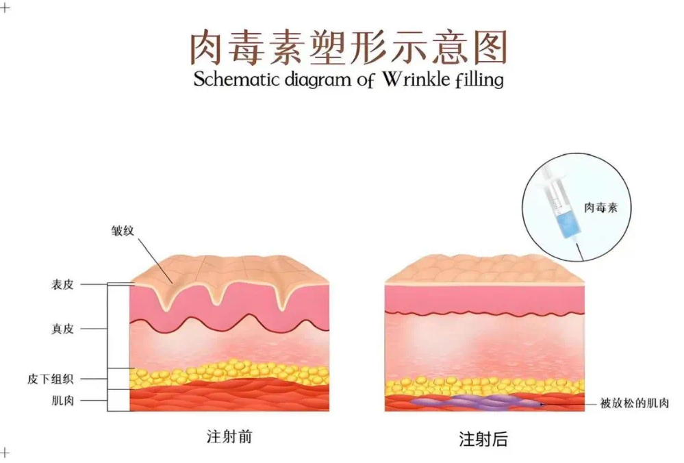 健康科普|肉毒素注射：既能抗衰又有风险？一篇看懂它的 “能” 与 “不能”