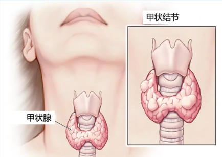 特色门诊|甲状腺结节门诊正式开诊！3分钟读懂“切还是不切