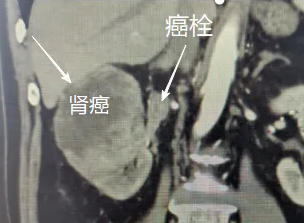 优势技术|勇克“癌栓”难关——我院成功完成高难度右肾癌伴肾静脉癌栓切除术