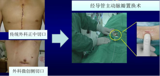 学科专栏|锦州市中心医院心内科团队采用极简式TAVR成功为高龄主动脉瓣重度狭窄患者完成瓣膜置换